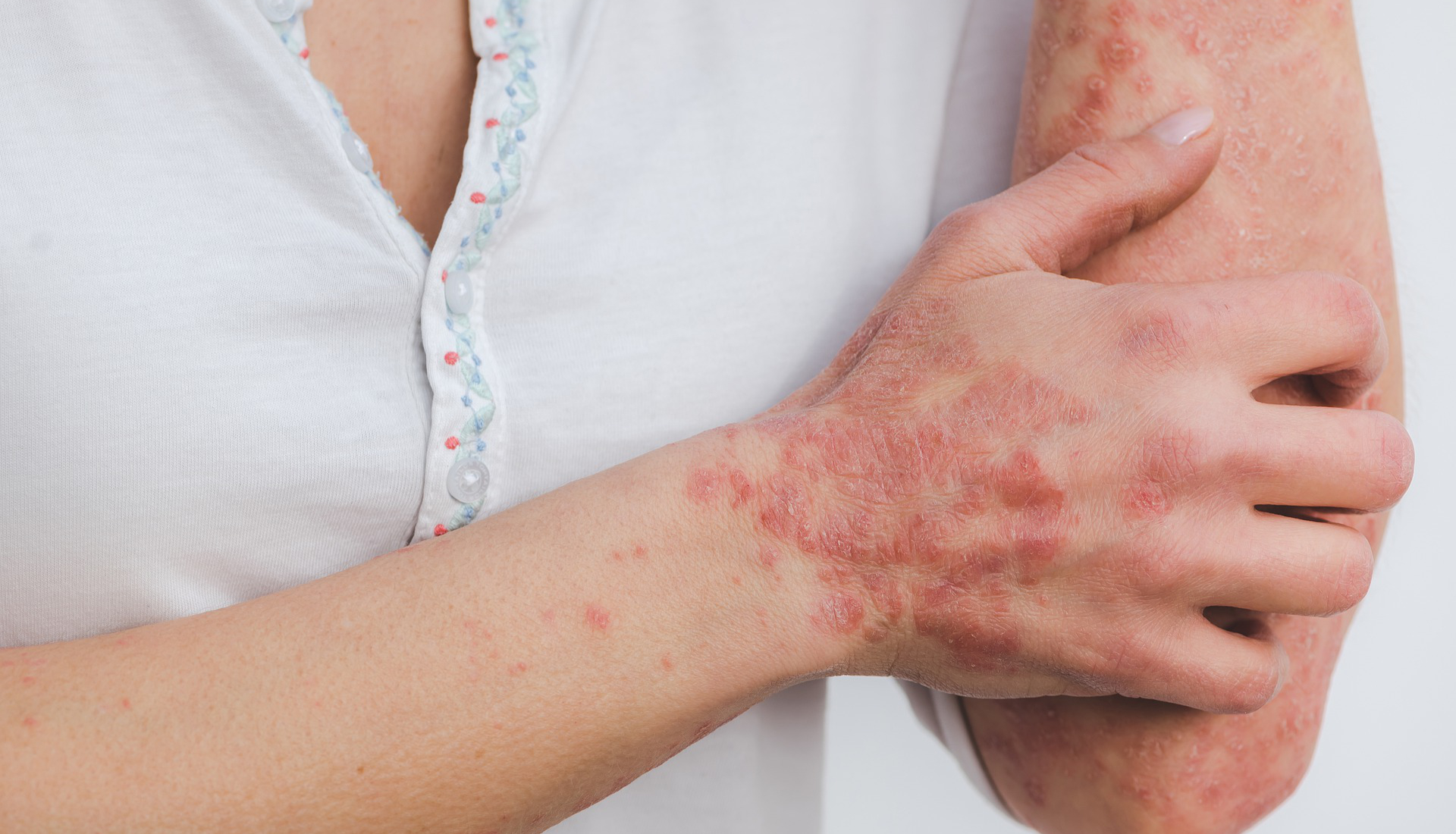 ISPUP conducts study on the prevalence of psoriasis in Portugal